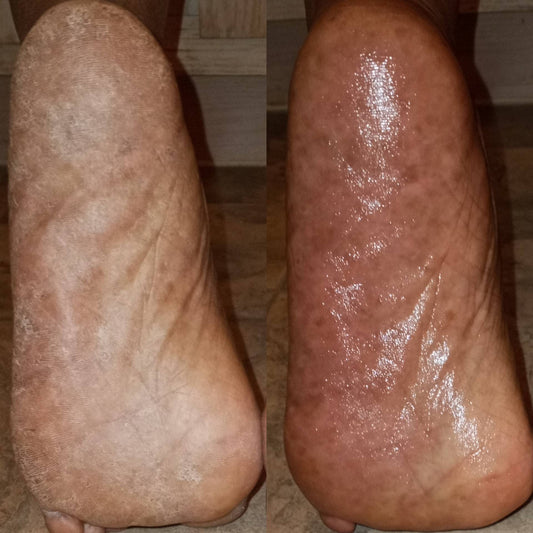 Peppermint Foot Cream – Moisturizer for Cracked Heels & Dry Feet